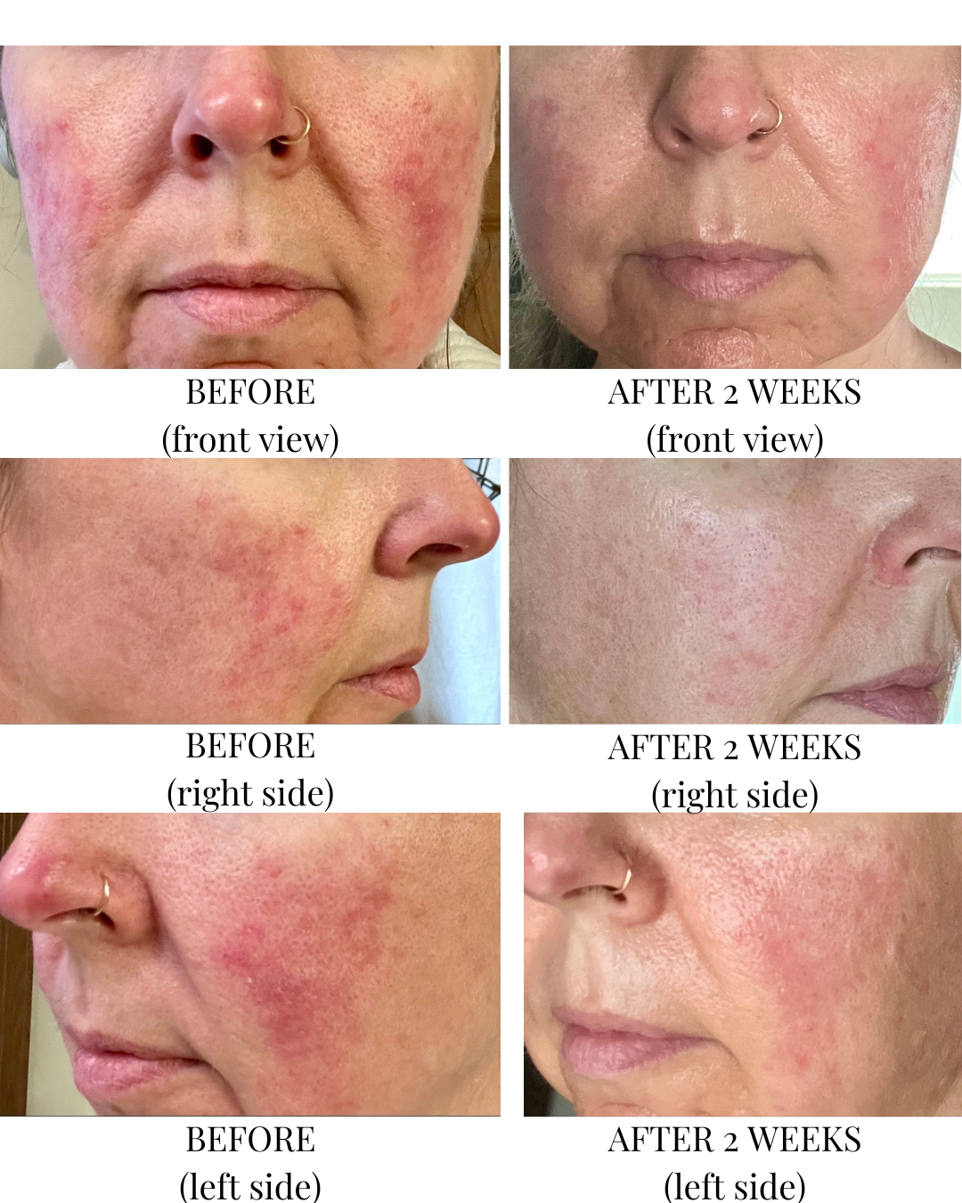 From Hiding Under Makeup to Glowing in the Sunshine: Jamie’s 2-Week Skin Transformation
