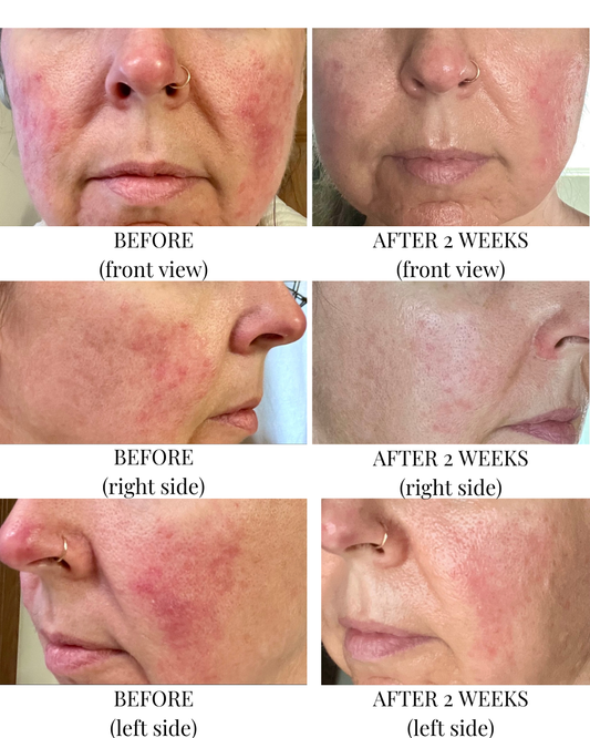 From Hiding Under Makeup to Glowing in the Sunshine: Jamie’s 2-Week Skin Transformation